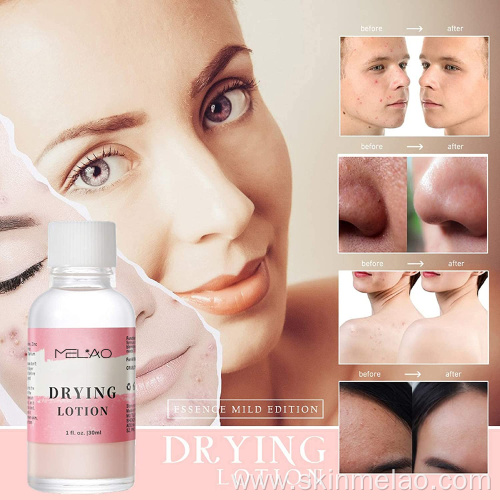 Effective Pimples Dark Spot Remover Cream Drying Lotion